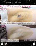 ミラドライ after画像 サムネイル用