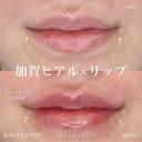 加賀ヒアル×リップ after画像 サムネイル用