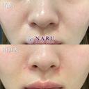 貴族ヒアルロン酸 before画像 サムネイル用