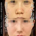 プロテーゼ＋鼻尖形成＋軟骨移植＋鼻柱下降＋鼻翼縮小 before画像 サムネイル用