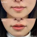 Cカールリップ(スマイルリップ+人中短縮ヒアル) before画像 サムネイル用