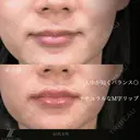 唇ヒアルロン酸 after画像 サムネイル用