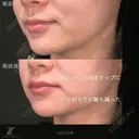 唇ヒアルロン酸 after画像 サムネイル用