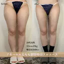 アキーセル太もも脂肪吸引 after画像 サムネイル用
