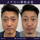 疲れ顔バイバイ👋切らないクマ治療 after画像 サムネイル用