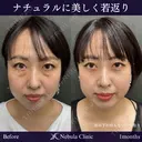 疲れ顔バイバイ👋切らないクマ治療 after画像 サムネイル用