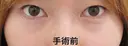 埋没法（週末二重術） before画像 サムネイル用