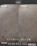 サリチル酸ピーリング＋リジュランi  before画像 サムネイル用