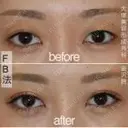 目元の印象アップ💞二重埋没 after画像 サムネイル用