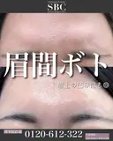 ボトックス注射(眉間) 7日後 サムネイル用