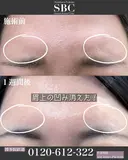 ボトックス注射(眉間) after画像 サムネイル用