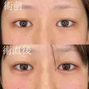 ヒアルロン酸注入（涙袋） after画像 サムネイル用
