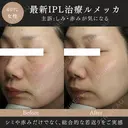 ルメッカ(IPL治療) after画像 サムネイル用