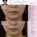 顎ヒアルロン酸 before画像 サムネイル用