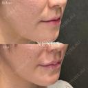 ヒアルロン酸（唇＋鼻翼基部） before画像 サムネイル用
