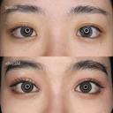 目頭切開 90日後 サムネイル用