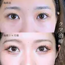 クマ取り  ”老け顔”や“お疲れ顔“とサヨナラ👋  after画像 サムネイル用