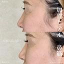 加賀ヒアル×鼻筋 after画像 サムネイル用