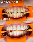 ホワイトニング🦷✨ before画像 サムネイル用