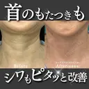 【首のしわ・たるみ解消】ネックリフト×ボライト2cc 1日後 サムネイル用