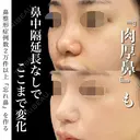 プロテーゼ、鼻尖形成、鼻尖部軟骨移植、鼻翼縮小、肉厚減幅 after画像 サムネイル用