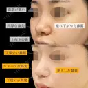 プロテーゼ、鼻尖形成、鼻尖部軟骨移植、鼻翼縮小、肉厚減幅 before画像 サムネイル用