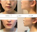 エラボトックス before画像 サムネイル用
