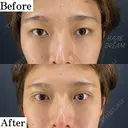 二重整形2点留め before画像 サムネイル用