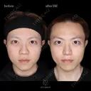 小鼻縮小＋鼻尖形成オープン法＋耳介軟骨移植 90日後 サムネイル用