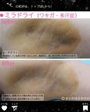 ミラドライ（ワキガ・多汗症） before画像 サムネイル用