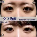 クマ治療 before画像 サムネイル用