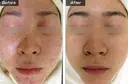 ニキビ治療☘️ケミカルピーリング before画像 サムネイル用
