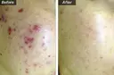 ニキビ治療☘️ケミカルピーリング after画像 サムネイル用