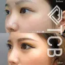 高くキレイな鼻筋へ🌹ヒアルロン酸注入💉 before画像 サムネイル用