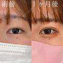 二重埋没法/ヒアルロン酸注入（涙袋） 30日後 サムネイル用