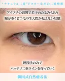 二重埋没(韓国式自然癒着法) before画像 サムネイル用