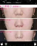小鼻縮小（鼻翼縮小） after画像 サムネイル用