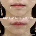 加賀ヒアル×リップ＋顎 before画像 サムネイル用