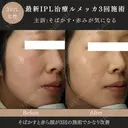 ルメッカ(IPL治療) before画像 サムネイル用