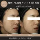 ルメッカ(IPL治療) after画像 サムネイル用
