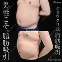 脂肪吸引（上下腹部） before画像 サムネイル用