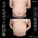 脂肪吸引（上下腹部） 90日後 サムネイル用