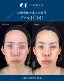 メソナJ 0日後 サムネイル用