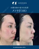 メソナJ before画像 サムネイル用