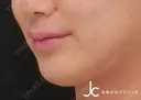 ヒアルロン酸注射 before画像 サムネイル用