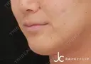 ヒアルロン酸注射 after画像 サムネイル用