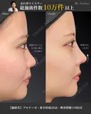 プロテーゼ ・鼻尖形成3D法 ・軟骨移植 ※MD式 before画像 サムネイル用