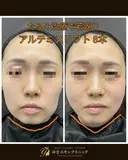 糸リフトで一気にシャープな輪郭に😌✨ after画像 サムネイル用