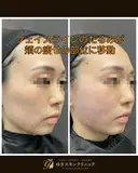 糸リフトで一気にシャープな輪郭に😌✨ after画像 サムネイル用
