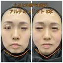 糸リフトで一気にシャープな輪郭に😌✨ after画像 サムネイル用